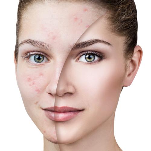 la médecine esthétique lutte contre l'acné