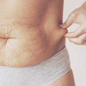 Raffermir le ventre : adieu la graisse et la peau du ventre fripée grâce à la cryolipolyse et la rédiofréquence