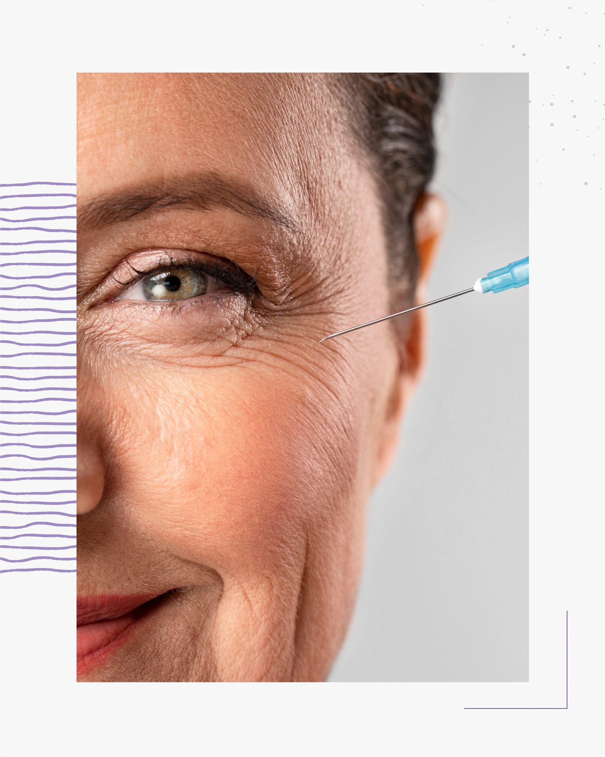 3 injections en nappage d'un gel de comblement à base de polynucléotides