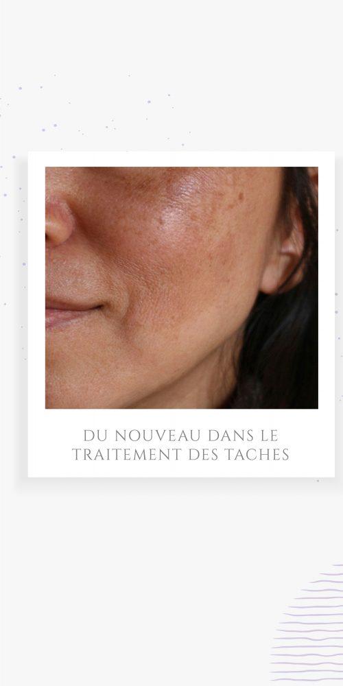 du nouveau dans le traitement des taches pigmentaires