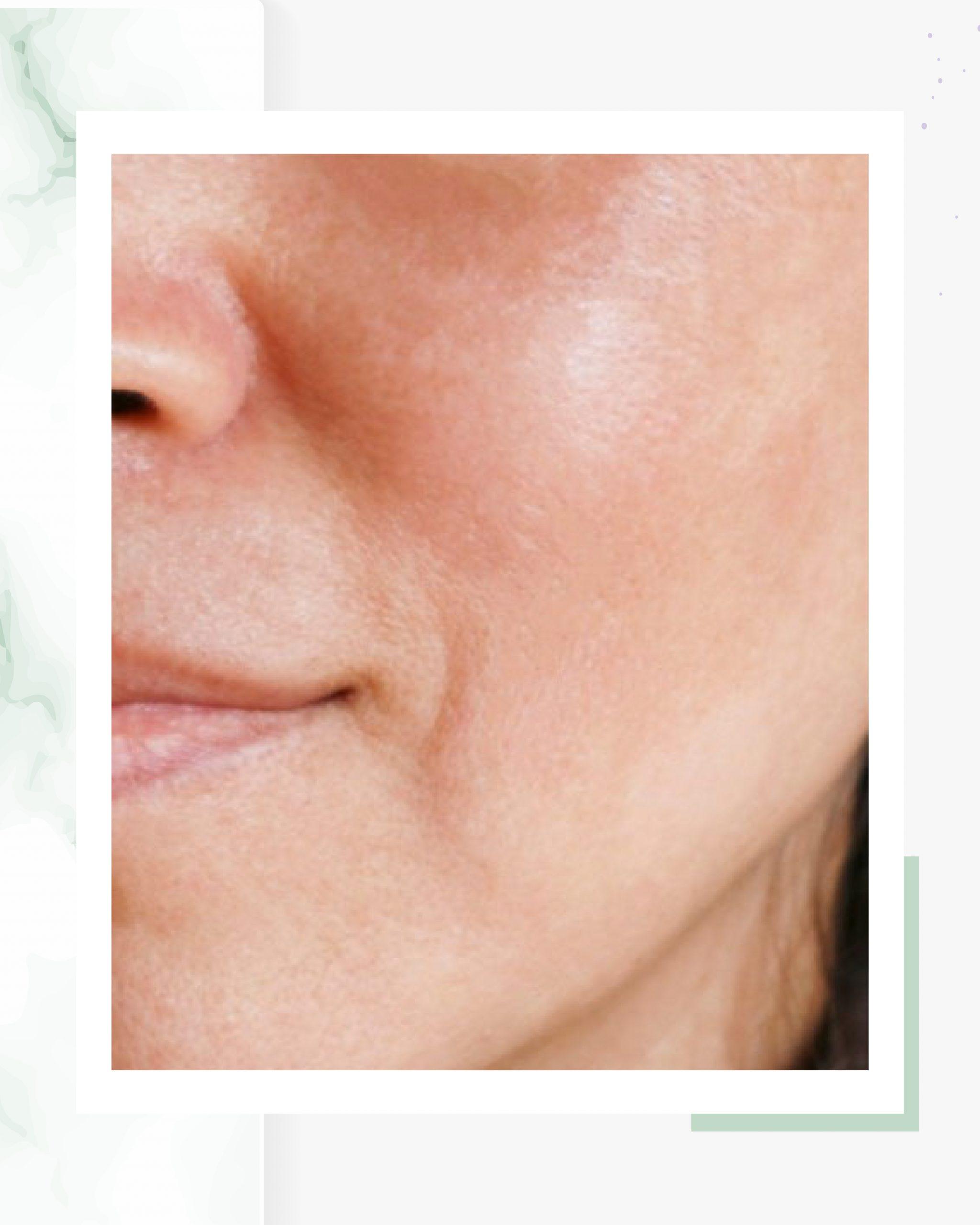 un nouveau programme de dépigmentation à base de peelings et de séances de microneedling