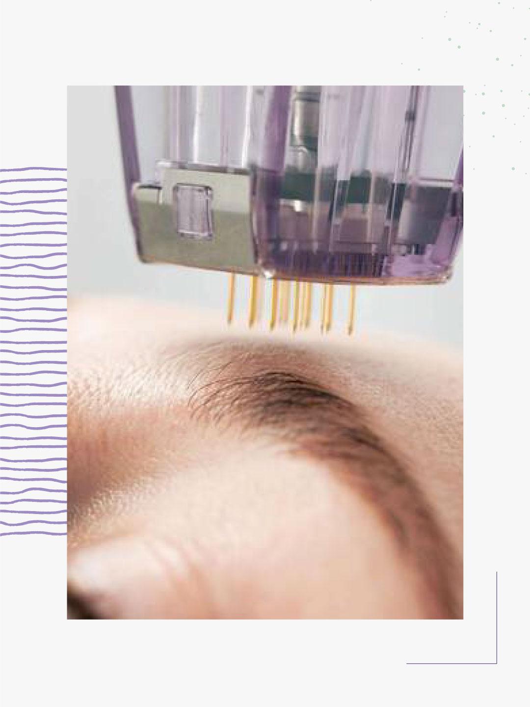 Prêt ( e ) à découvrir comment Morpheus 8 peut réactiver la jeunesse de votre peau ?