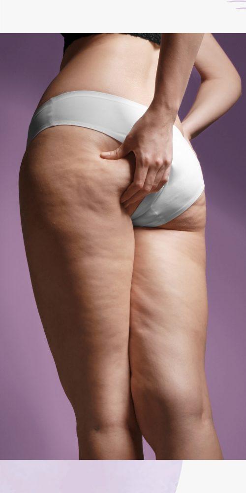 Mésothérapie et cellulite