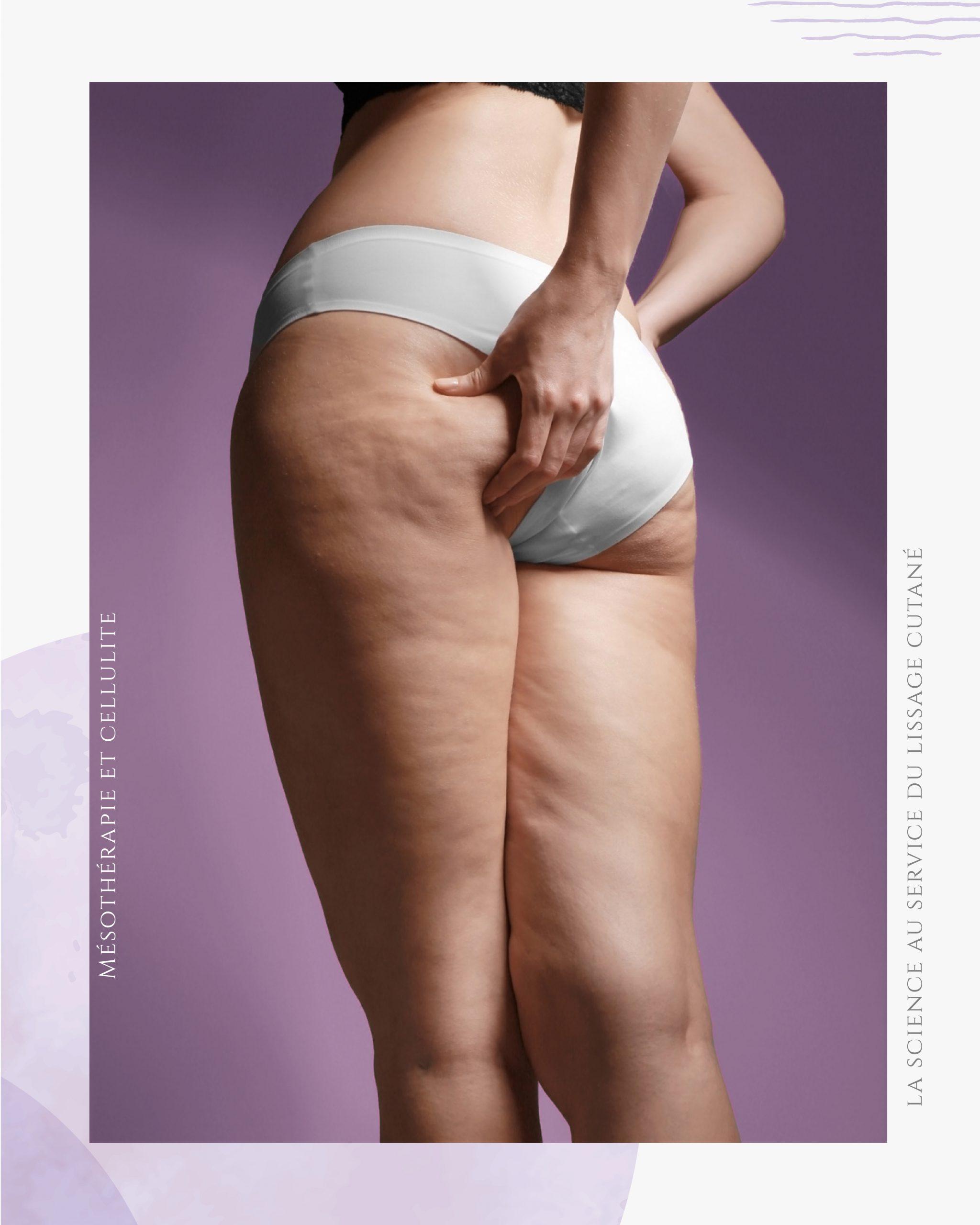 Mésothérapie et cellulite 