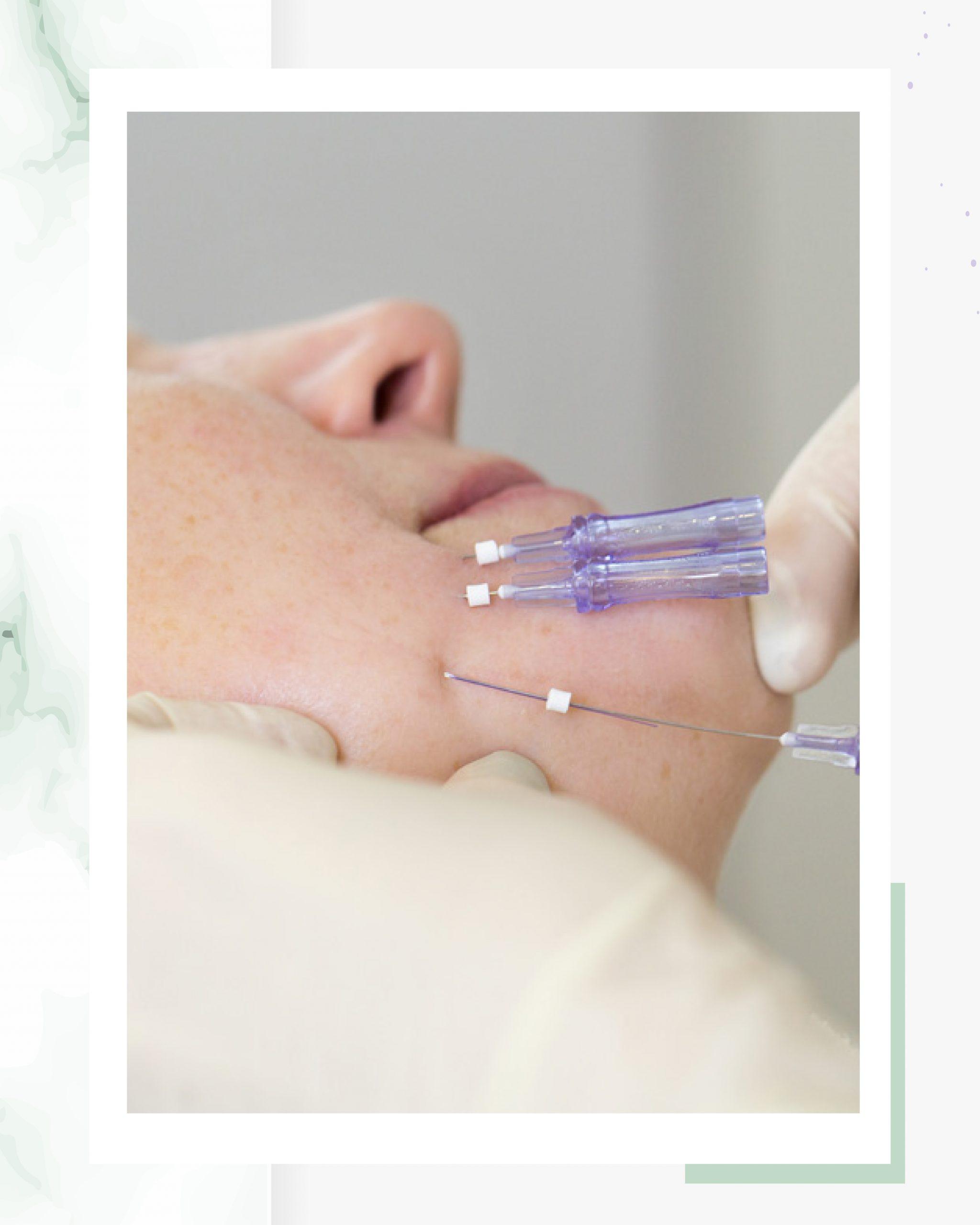 Les fils résorbables