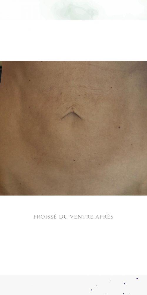 après traitement médecine esthétique, la peau du ventre est retendue et défrippée