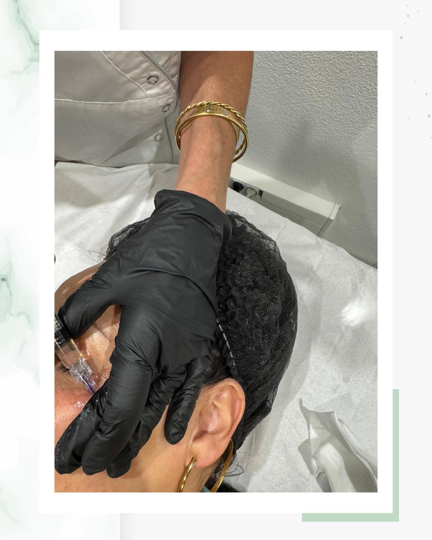 2 à 3 séances de polynucléotides pour un regard défatigué