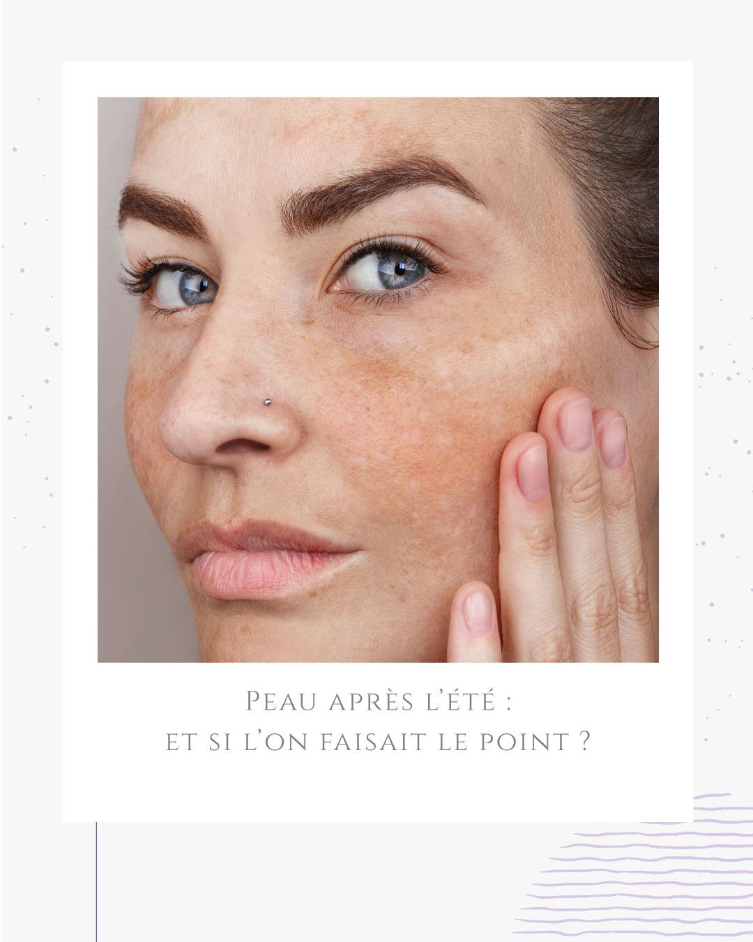 Peau après l’été : et si l’on faisait le point ?